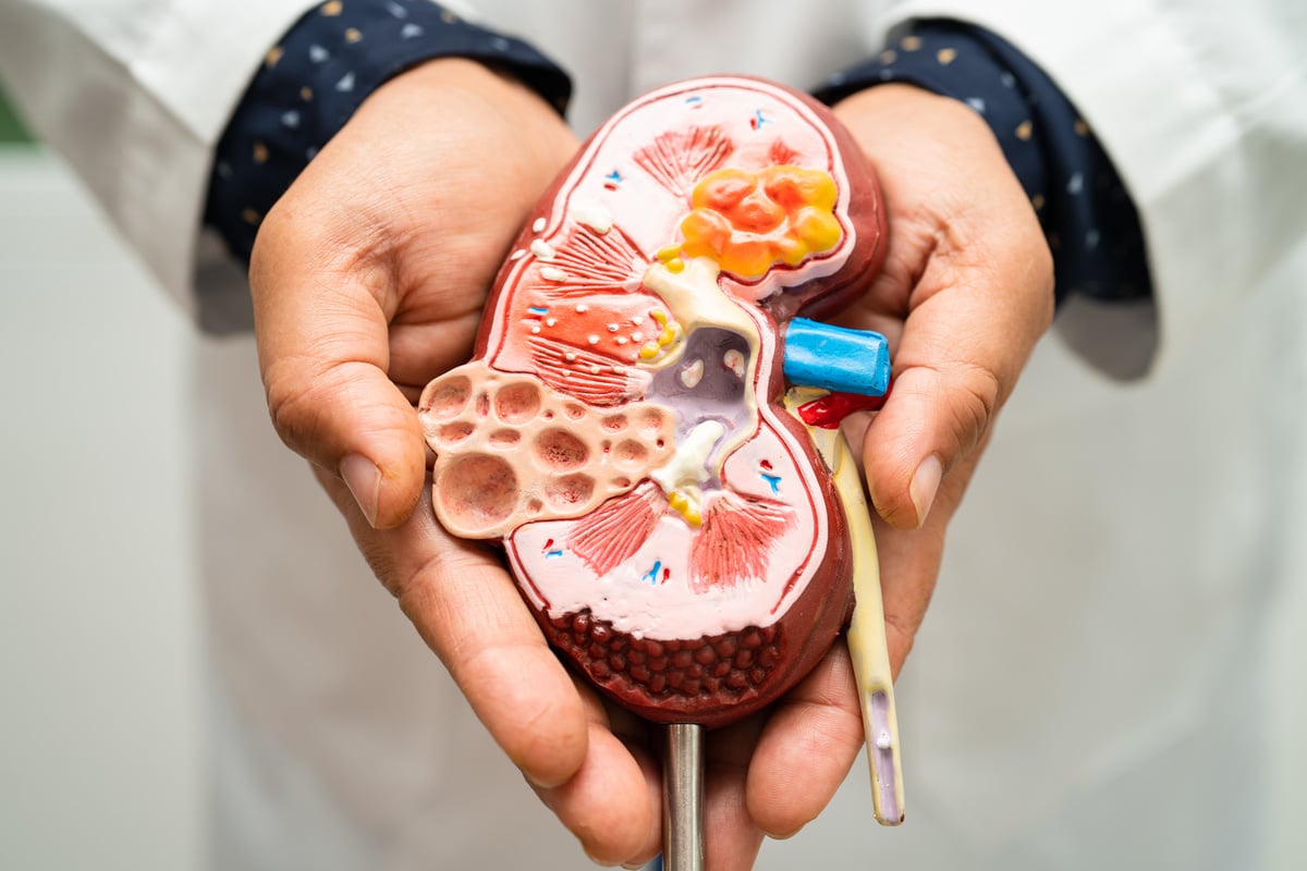 Kidney disease, Chronic kidney disease ckd, Doctor hold model to